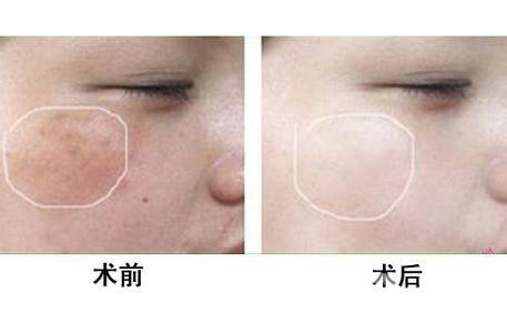 *風(fēng)范祛斑多少錢一次 與哪些因素有關(guān)？