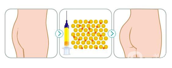 做自體脂肪豐臀手術(shù)的危害有哪些？
