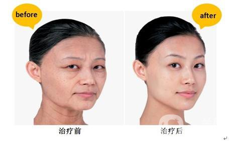 *生物除皺*果怎么樣？能持續(xù)多久？