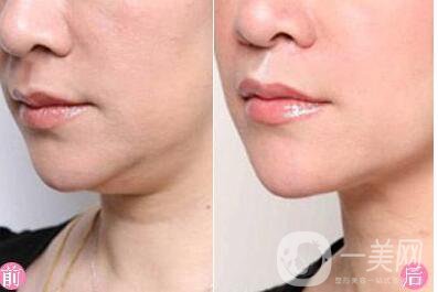 雙下巴抽脂,多少錢