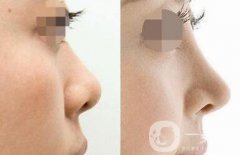 鼻部手術(shù)術(shù)后注意事項(xiàng) 鼻部手術(shù)整形術(shù)后如何護(hù)理