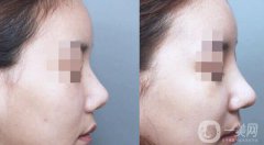 隆鼻后消腫的方法 隆鼻后怎么護(hù)理恢復(fù)快