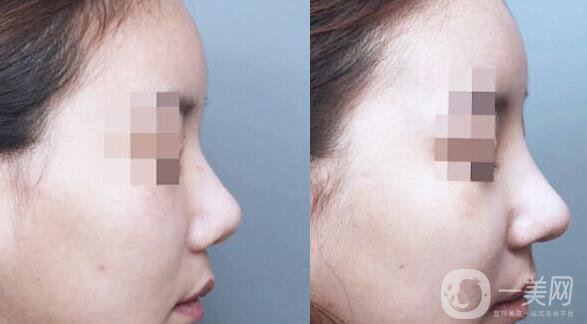 隆鼻后消腫的方法 隆鼻后怎么護(hù)理恢復(fù)快