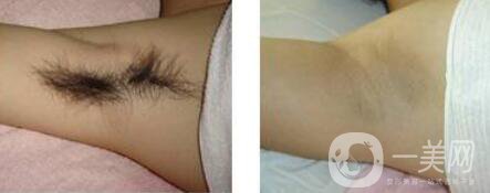 激光脫毛信息介紹 哪個醫(yī)院做激光脫毛好