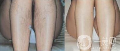 激光脫毛信息介紹 哪個醫(yī)院做激光脫毛好