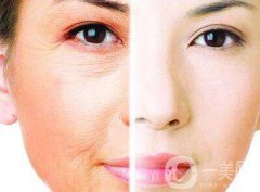 祛皺多少錢 祛皺價格一般是多少