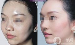 鼻部手術(shù)恢復(fù)期注意事項 鼻部手術(shù)術(shù)后護理