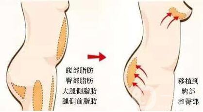 上海,自體脂肪豐臀,價格