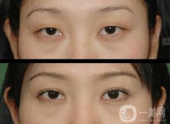 北京哪家醫(yī)院割雙眼皮果好？