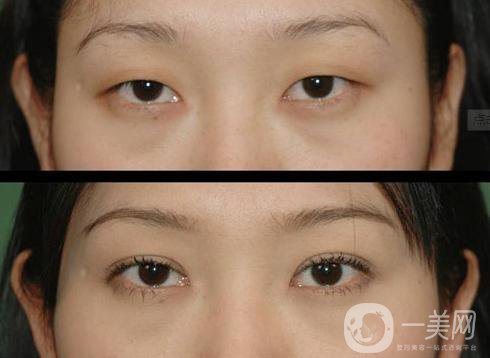 北京哪家醫(yī)院割雙眼皮*果好？