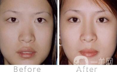 硅膠墊鼻梁能保持多久 硅膠隆鼻保持幾年