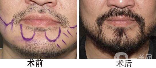 植胡須費用  胡須種植手術(shù)要多少錢