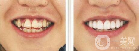 哪種烤瓷牙比較好 烤瓷牙修復(fù)圖