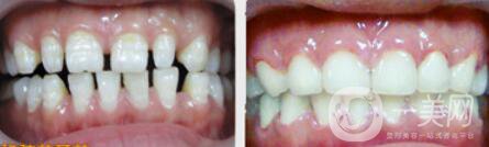 哪種烤瓷牙比較好 烤瓷牙修復(fù)圖