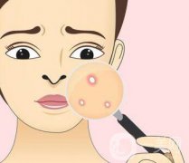 快速*去痘印的方法有哪些？