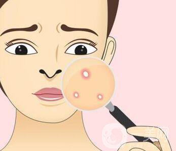 快速*去痘印的方法有哪些？