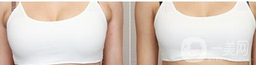 副乳吸脂,風(fēng)險(xiǎn)