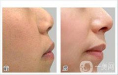 光子嫩膚前后*果嗎 果怎么樣？