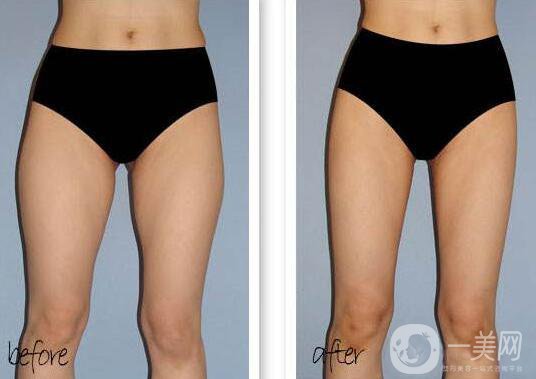 超聲波抽脂缺點(diǎn) 超聲波抽脂的缺點(diǎn)有哪些