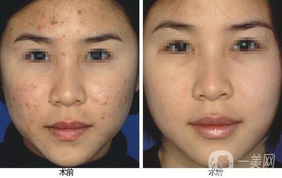 像素激光去痘,價格