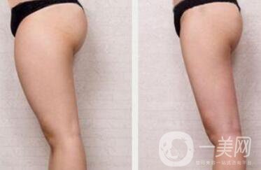 360度環(huán)形抽脂價(jià)格 吸脂減肥*果圖