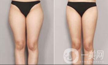 360度環(huán)形抽脂價(jià)格 吸脂減肥*果圖