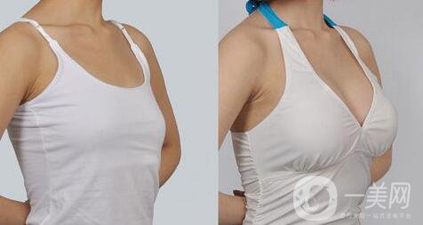 妙桃豐胸一次多少錢 妙桃假體隆胸具體價格