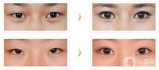 做開內(nèi)外眼角手術(shù)需要多少錢？