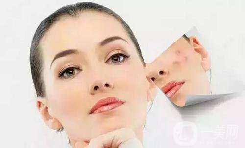 做一次果酸換膚大概需要多少錢？