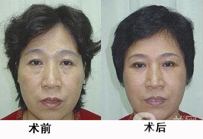 熱瑪吉除皺*果怎么樣？有哪些優(yōu)勢？