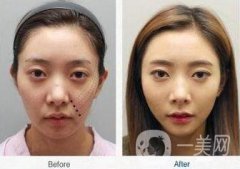 塑美極面部提升價(jià)格 塑美極面部提升要多少錢