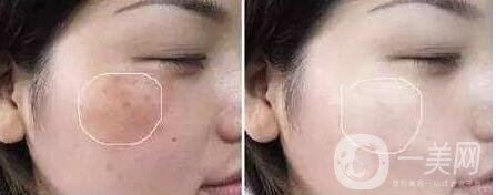 果酸換膚,多少錢