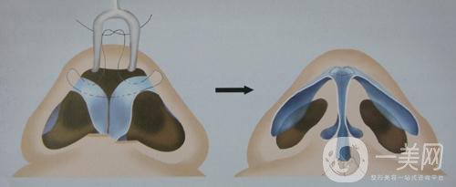 耳軟骨墊鼻梁大概需要多少錢呢？