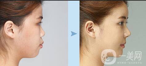雙下巴抽脂手術(shù)一般需要多少錢？