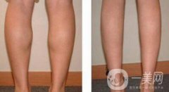 注射注射瘦臉瘦腿*嗎 打注射瘦臉注射瘦腿怎么樣