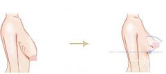 如何縮胸 胸部過(guò)大要怎么縮小