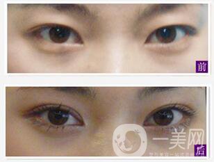 不開刀的雙眼皮方式有哪幾種？