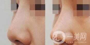 耳軟骨墊鼻尖是*嗎 耳軟骨墊鼻尖怎么樣