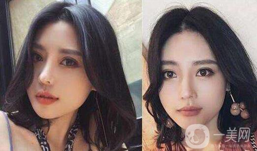 下頜角截骨手術(shù)費用需要多少？