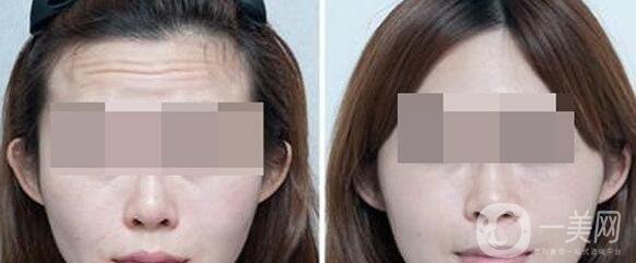 抬頭紋重怎么辦 快速去除抬頭紋的方法