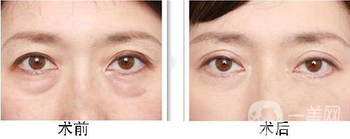 超聲波去眼袋多少錢 超聲波去眼袋價格詳情