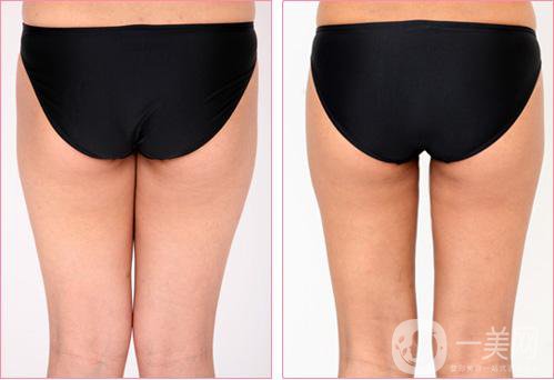上臀吸脂減肥術(shù)價(jià)格一般是多少錢？