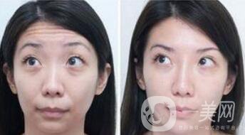 天生抬頭紋怎么消除 如何輕松去除抬頭紋介紹