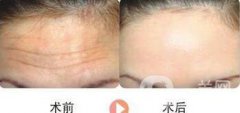 怎么治抬頭紋 超*的去抬頭紋方法介紹