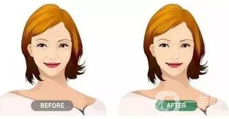 *生物除皺,*果,維持時間