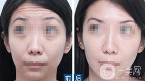 怎么治抬頭紋 超*的去抬頭紋方法介紹