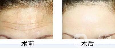 抬頭紋怎么治 消除抬頭紋*辦法