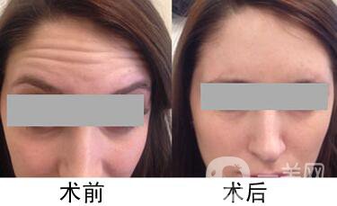 抬頭紋很重怎么辦 什么方法能夠去除抬頭紋