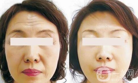 抬頭紋很重怎么辦 什么方法能夠去除抬頭紋