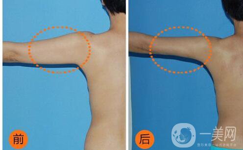 水動(dòng)力溶脂,減肥,價(jià)格